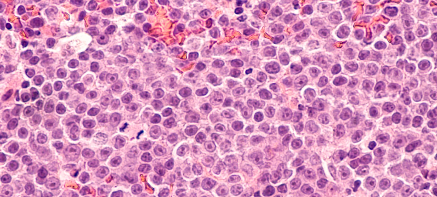 image of diffuse large B-cell lymphoma cells from under a microscope