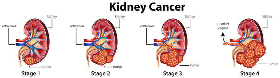 Stages of kidney cancer