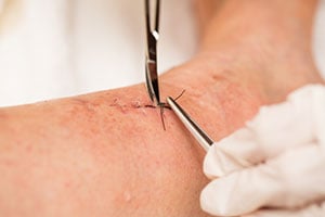 skin excision to treat basal carcinoma