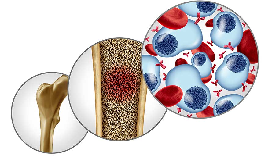 multiple myeloma tumor in a bone