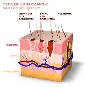 Skin Cancer Stages Skin Cancer Stages