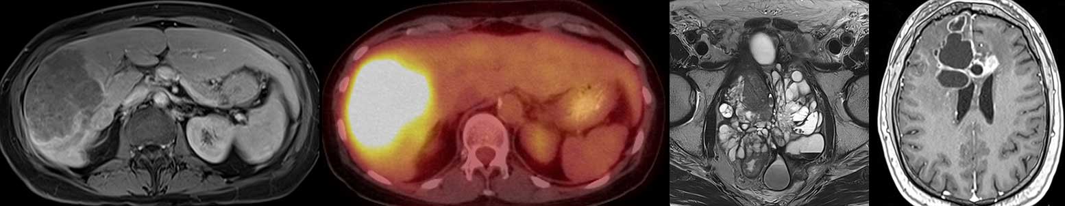 imaging from four cancer patients