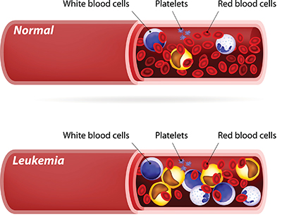 Graphic showing how blood cells different in leukemia