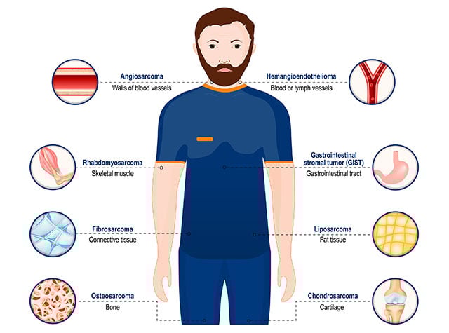 illustration showing types of sarcoma