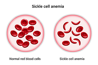 graphic illustration normal red blood cells and sickle cell disease