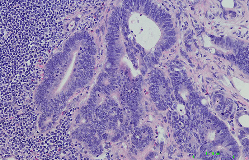 cancer cells shown under microscope