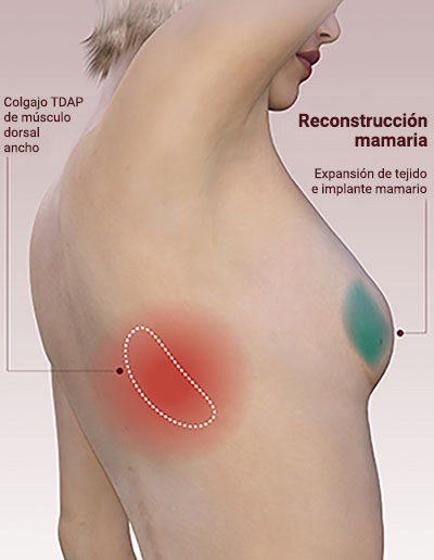 reconstrucción mamaria