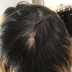 Mole on Martina Yates Head