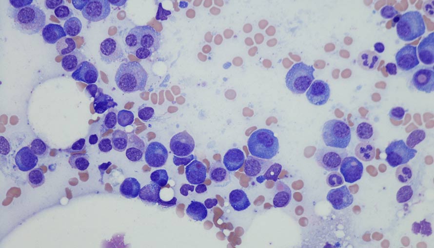 plasma cell myeloma from bone marrow aspirate