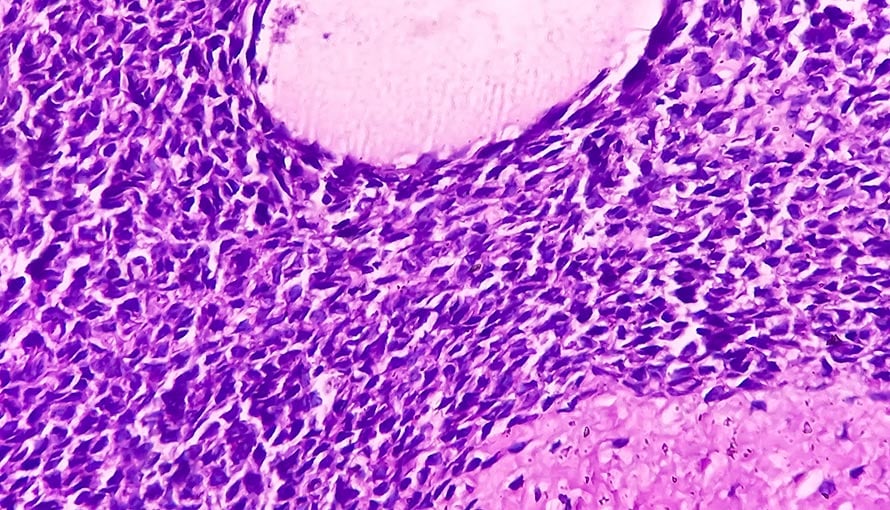 synovial sarcoma cells