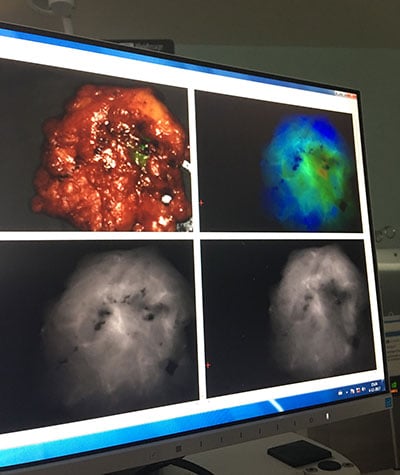 After surgeons remove the tumor, they use a near-infrared camera to identify any cancer left behind.