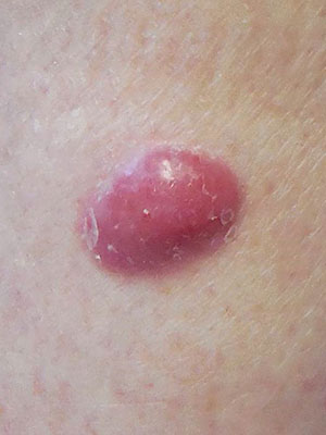 photo of early case of Merkel cell carcinoma showing small purple bump under skin