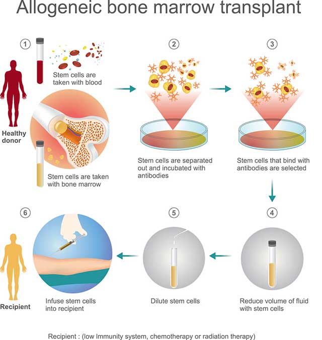 Allogeneic Stem Cell Transplant Moffitt