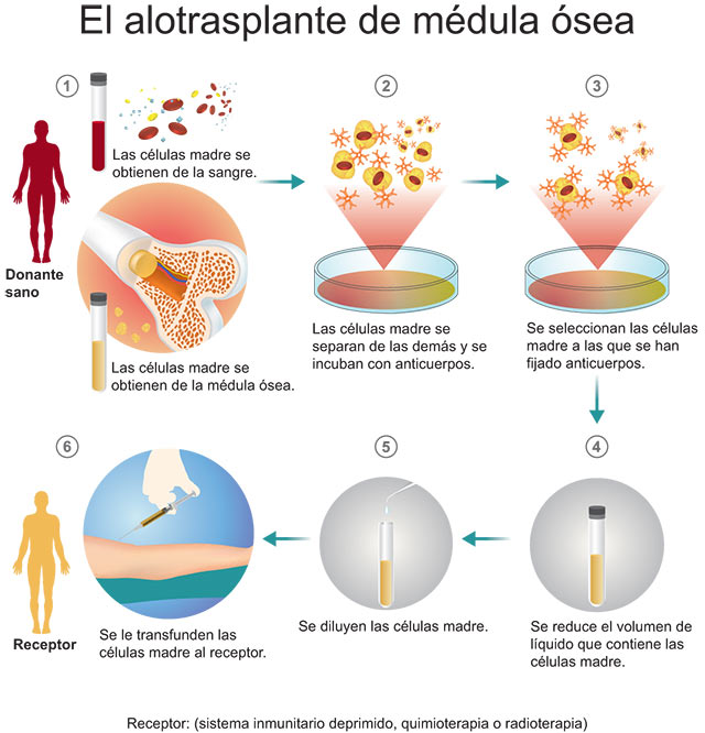 alotrasplante de c&eacute;lulas madre