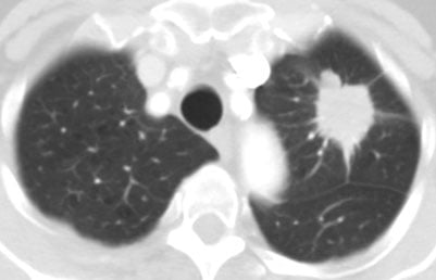 lung nodule on CT scan
