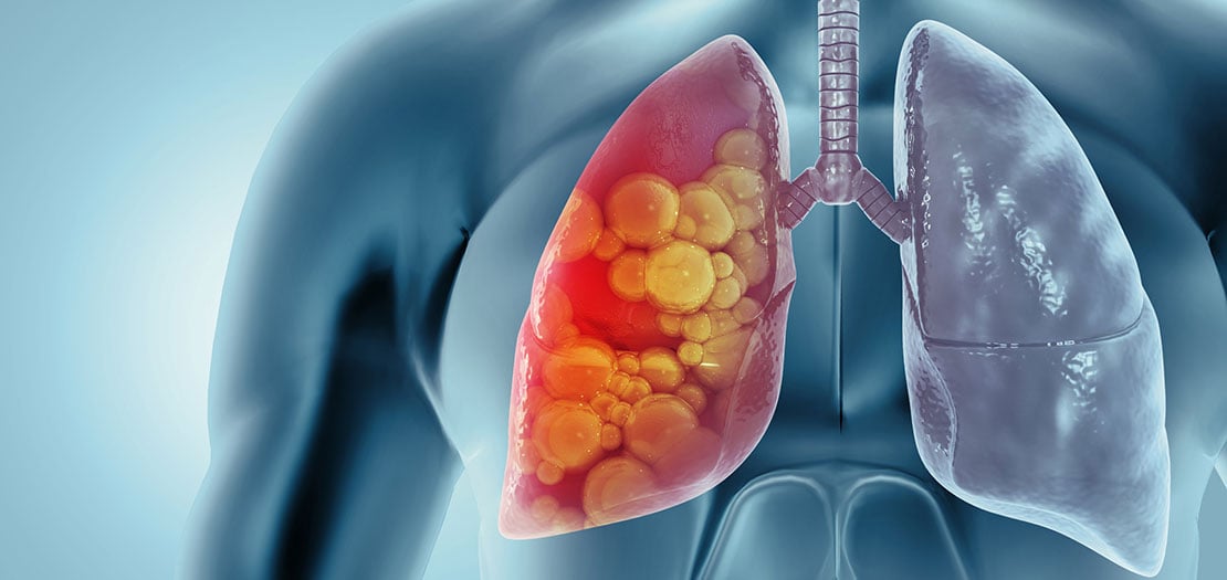 cancerous tumor shown on lung