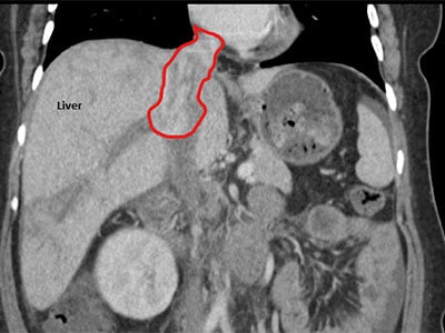 Morel's tumor was very large and quickly growing into her heart.