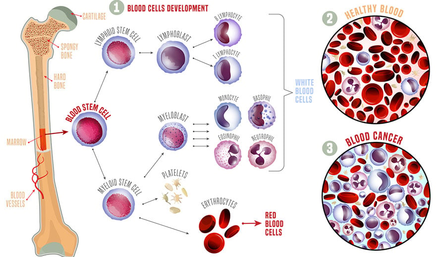 Graphic showing how bone marrow is replaced in a BMT or bone marrow transplant