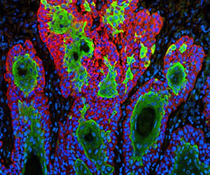 squamous cell carcinoma