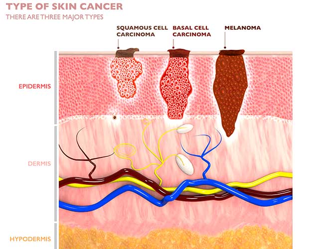 graphic showing depth of squamous cell carcinoma
