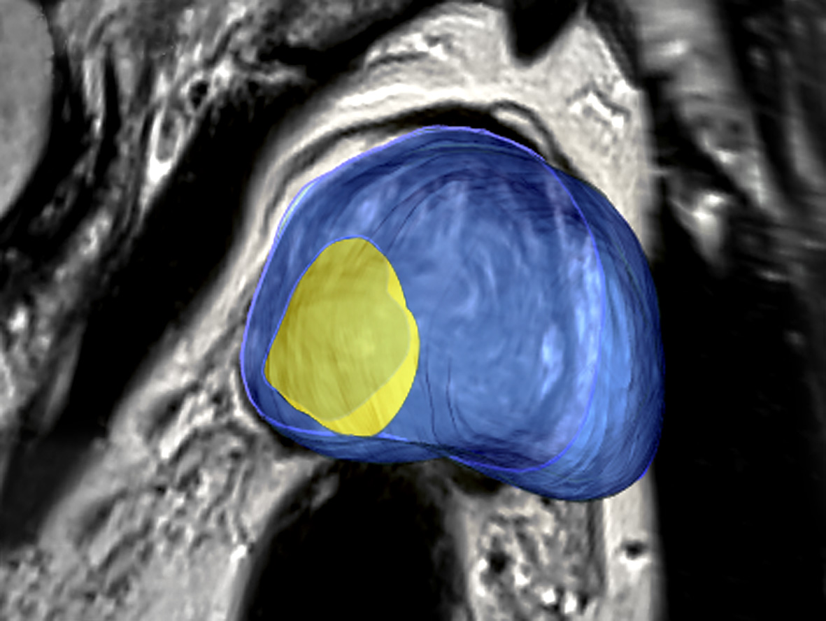 Prostate Cancer Nomograms 