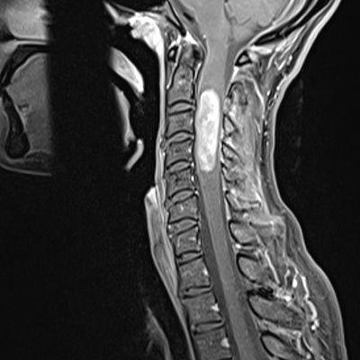 This MRI scan shows Devitt's tumor was in the upper region of her spinal cord, near the brain stem.