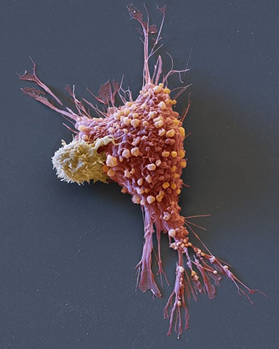 At right, colored scanning electron micrograph of a breast cancer cell (pink) being attacked by a chimeric antigen receptor T cell (yellow). Courtesy of Eye of Science.