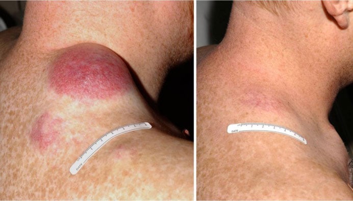 un paciente con melanoma avanzado antes y después de recibir la terapia con linfocitos infiltrantes de tumor