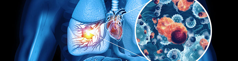Can Viruses Be Used to Treat Lung Cancer?