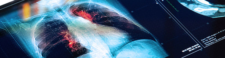 Combination Therapy Shows Mixed Results in First Randomized Trial for Lung Cancer