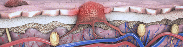 Comparing Therapy Options for Melanoma In-Transit Metastases