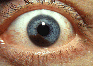 Melanoma of the iris of an eye