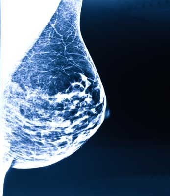 x-ray image of breast cancer in a stage