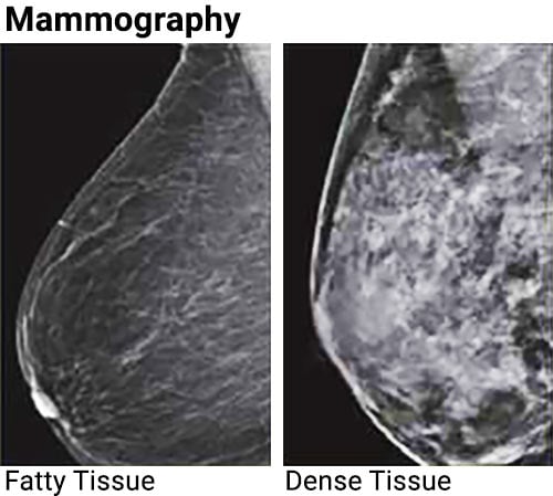 Side-by-side mammograms showing examples of fatty and dense tissue