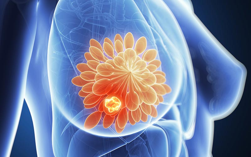breast tumor