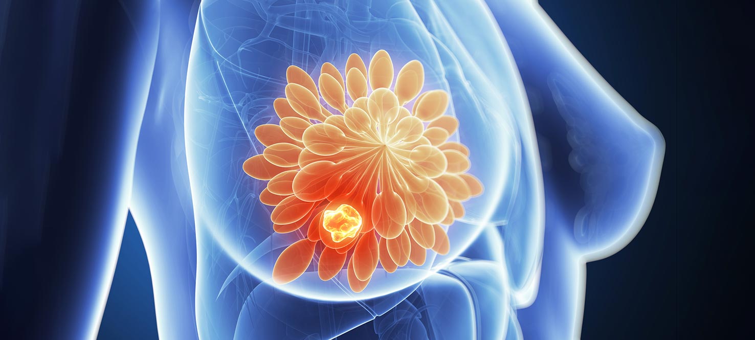 breast tumor