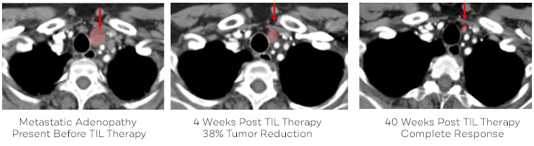 lung cancer image scans