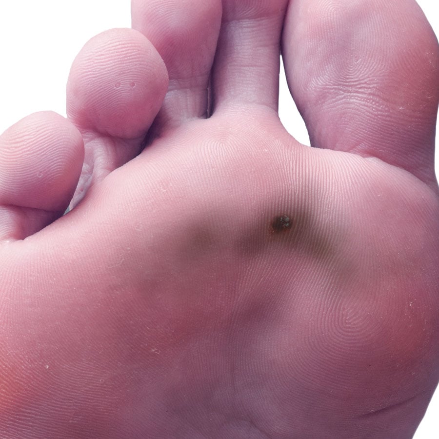 Acral lentiginous melanoma
