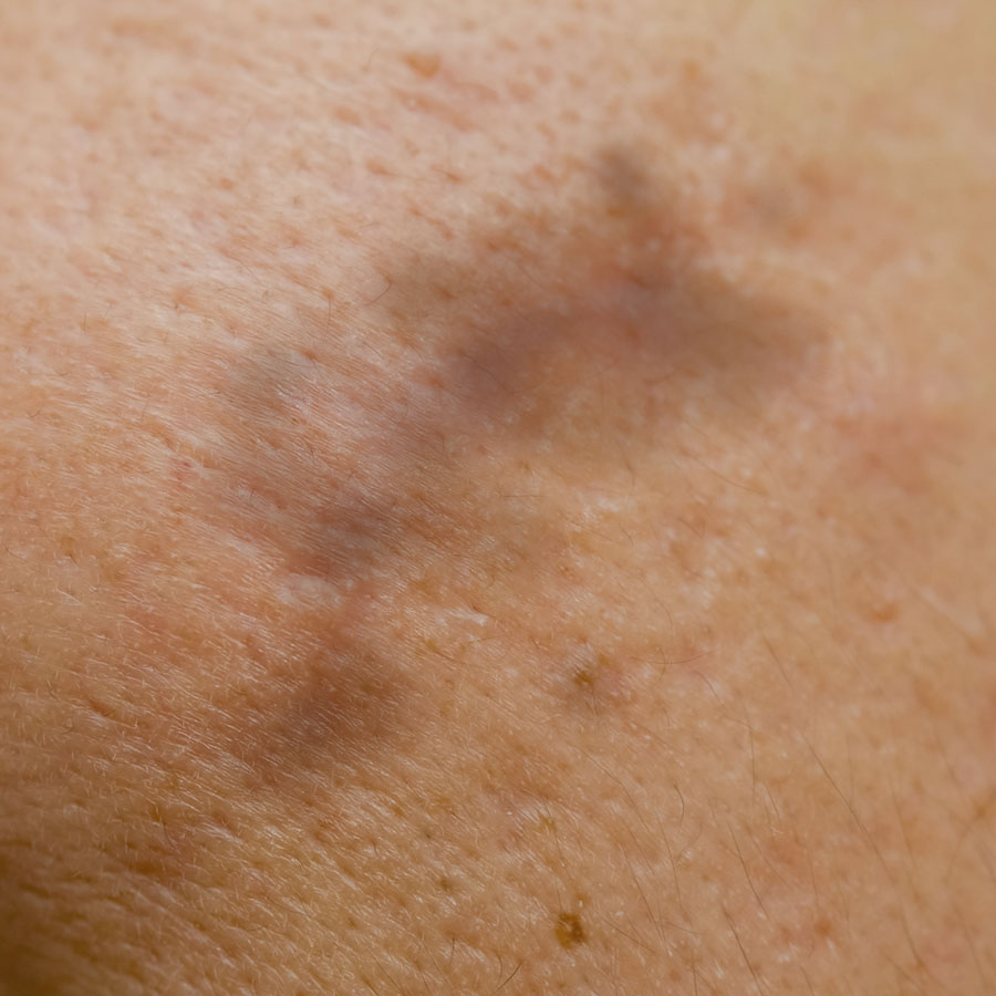 Lentigo maligna melanoma