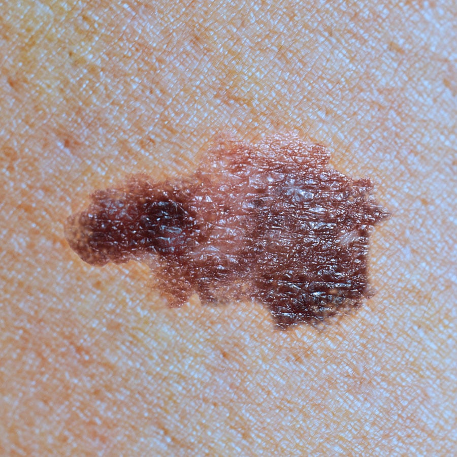Superficial spreading melanoma