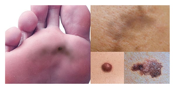 Melanoma Signs & Symptoms