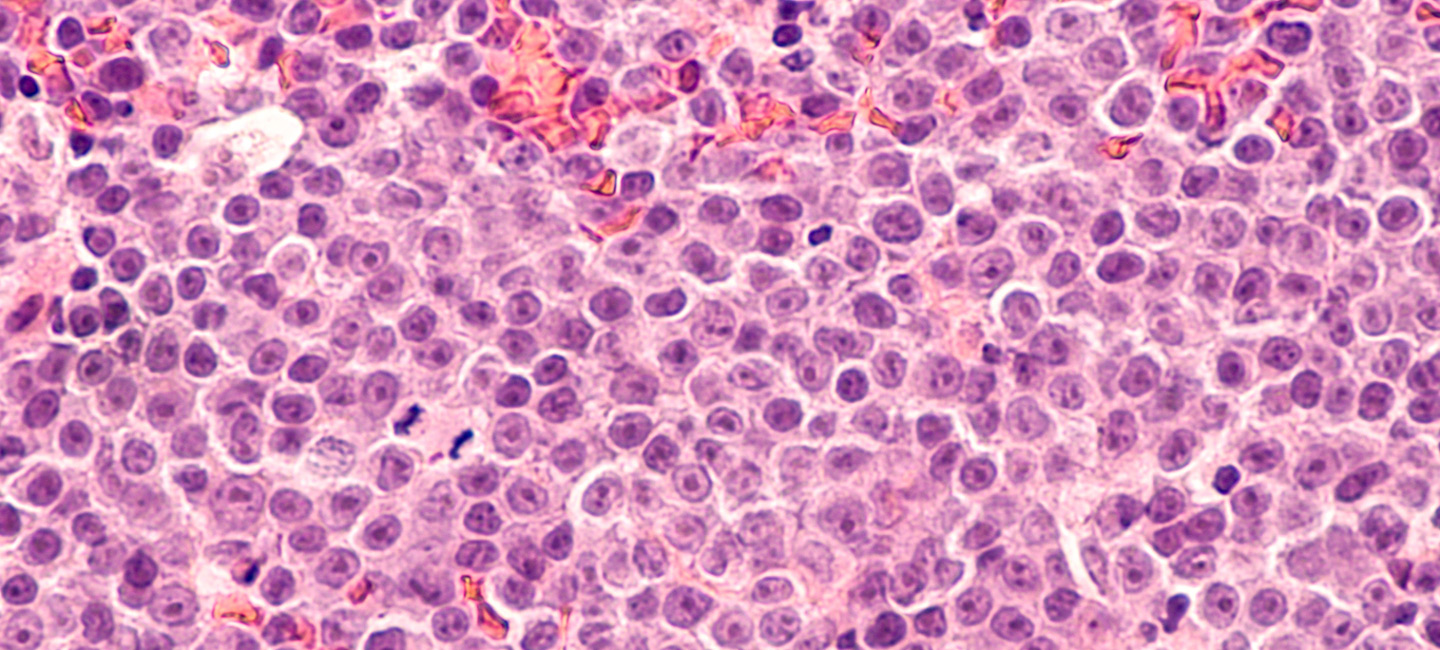 image of diffuse large B-cell lymphoma cells from under a microscope