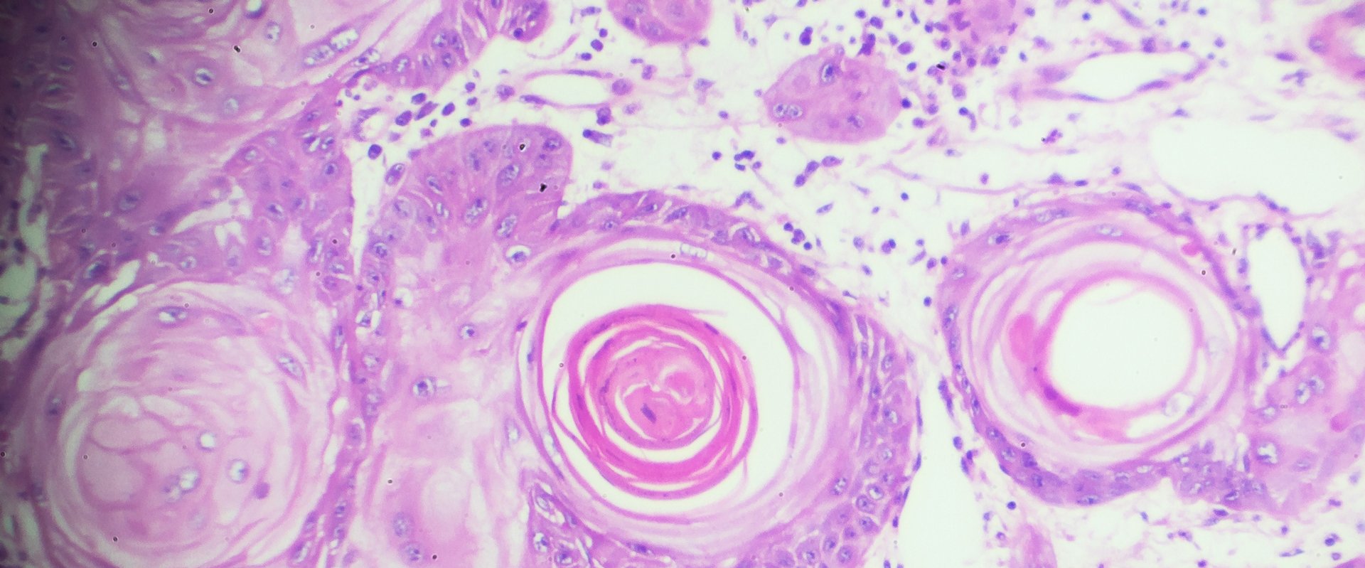 image of squamous cell carcinoma cells under a microscope 